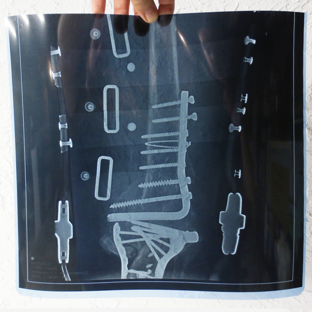 Vintage Genuine Medical X-Ray 14X14" of a Fractured Knee with Multiple Medical Screws, Surgical Plates and Straps, Human Skeleton