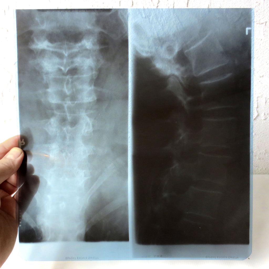 Vintage Genuine Medical X-Ray 10X11" of a Patient's Neck Cervical Vertebrae, Human Skeleton X-Ray on Dupont Chronex Thick Plastic Sheet