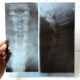 Vintage Genuine Medical X-Ray 10X11" of a Patient's Neck Cervical Vertebrae, Human Skeleton X-Ray on Dupont Chronex Thick Plastic Sheet