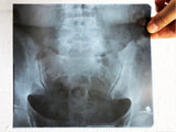 Vintage Genuine Medical X-Ray 9X8" of a Patient's Sacrum & Lumbar Vertebrae, Human Skeleton X-Ray, Dupont Chronex Quanta Thick Plastic Sheet